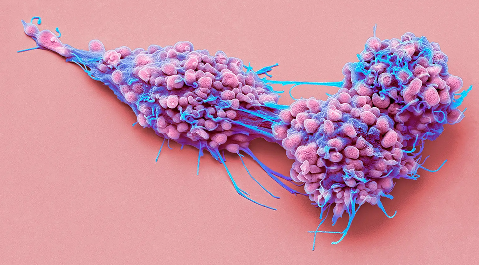 ایمونوتراپی نویدبخش درمان مشکل سرطان تخمدان HRP است